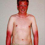 funny-sunburn-13